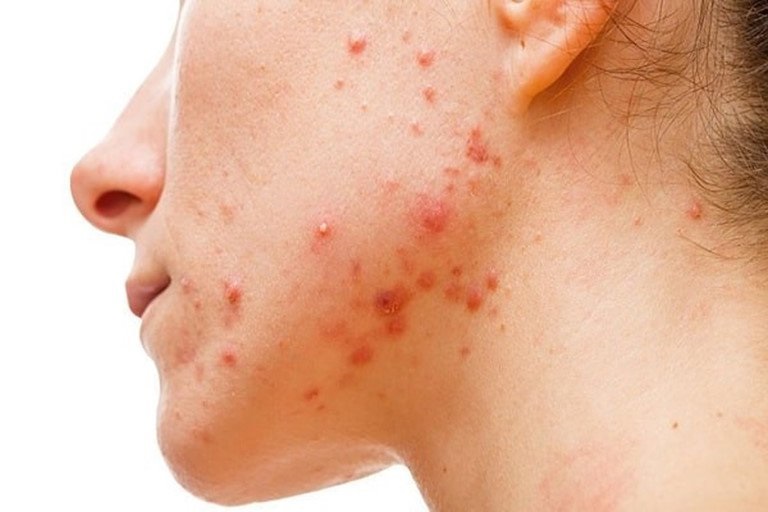 Điều trị mụn kết hợp chiếu ánh sáng sinh học