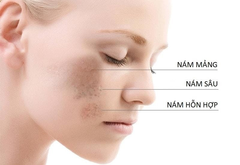 Điều trị nám, tăng sắc tố bằng kĩ thuật Meso - Meline