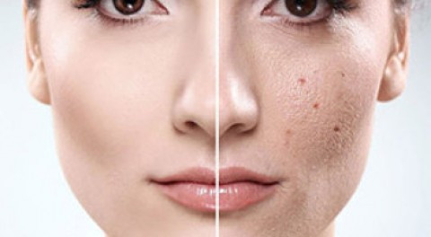 Điều trị sẹo lõm bằng công nghệ PRP