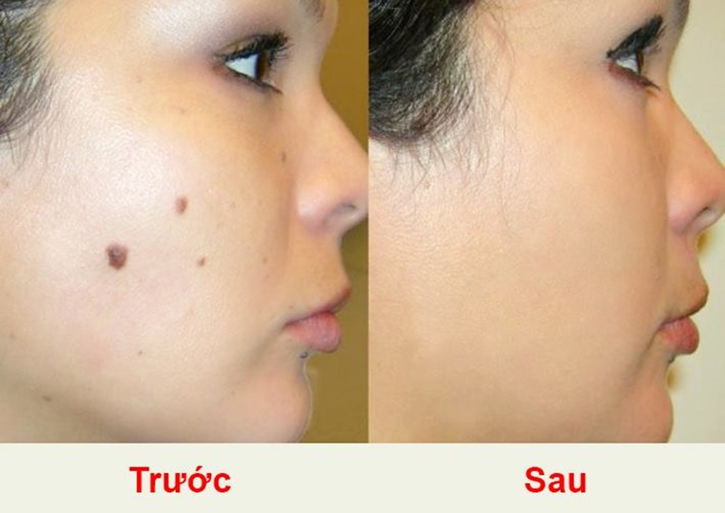 Đốt nốt ruồi : 2 nốt đầu tiên