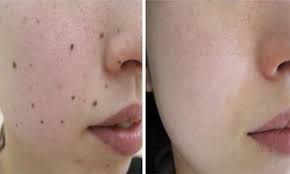Đốt nốt ruồi : Từ nốt thứ 3 trở lên