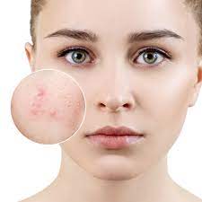 Peeling điều trị mụn, thâm mụn