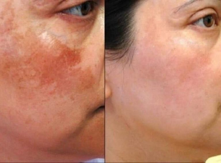 Peeling điều trị sạm, nám, tăng sắc tố da
