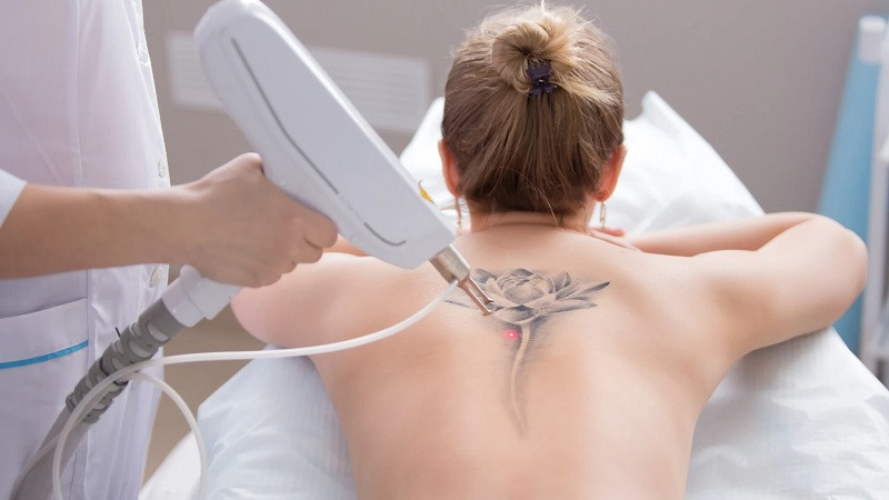 Xóa xăm theo diện tích: >10cm